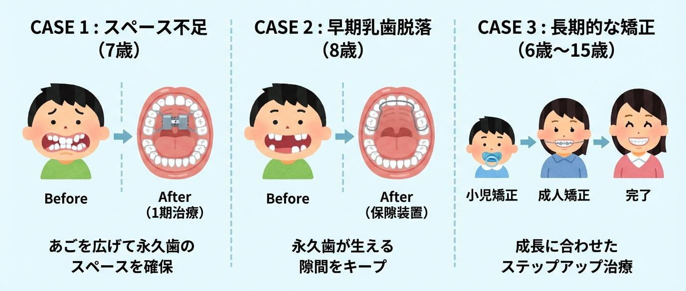 小児矯正の症例