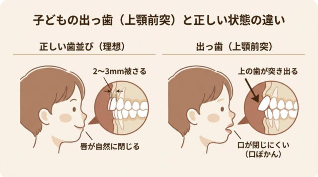 子どもの出っ歯（上顎前突）とは？正しい状態との違い